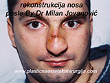 After the plastic surgery After the plastic surgery