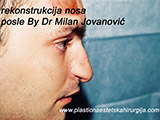 After the plastic surgery After the plastic surgery