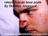 After the plastic surgery After the plastic surgery
