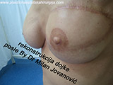 After the plastic surgery After the plastic surgery