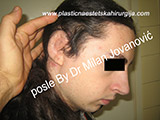 After the plastic surgery After the plastic surgery
