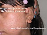 After the plastic surgery After the plastic surgery