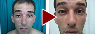 Before and after the plastic surgery Before and after the plastic surgery