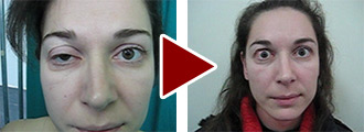 Before and after the plastic surgery Before and after the plastic surgery