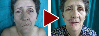 Video recording of the patient with facial nerve paralysis before and after the surgery ‐ By Dr Milan Jovanovic